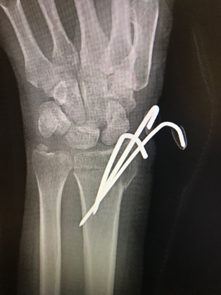 an x-ray of Maja's broken and dislocated wrist